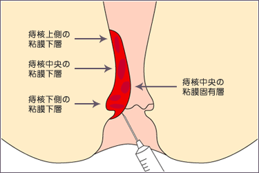 どのようにお尻に注射をするのですか？